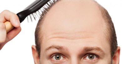 Untuk Mengatasi Rambut Sebelum Botak Lakukan 7 Hal Ini