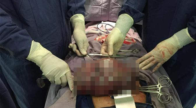 Anggap Sepele Sembelit Seorang Gadis Dikejutkan dengan Pernyataan Dokter