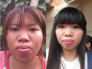 Dulu Sering Dibully Wajah Baru Gadis Vietnam Ini Bikin Netizen Melongo