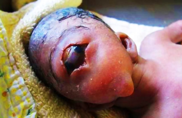 Kelahiran Bayi Bermata Satu Ini Penyebab dan Cara Mencegah