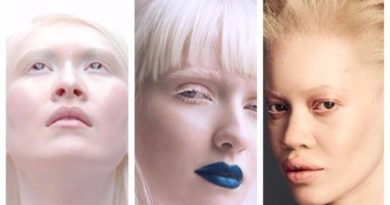 Kenalan dengan 3 Model Albino Beda Ras, Salah Satunya Albino Tercantik di Dunia