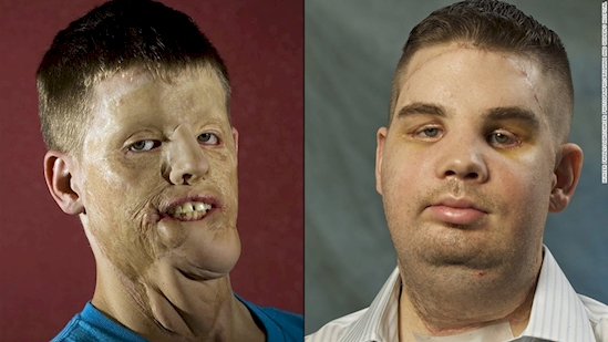 Before After 6 Foto transplantasi wajah bukti canggihnya medis