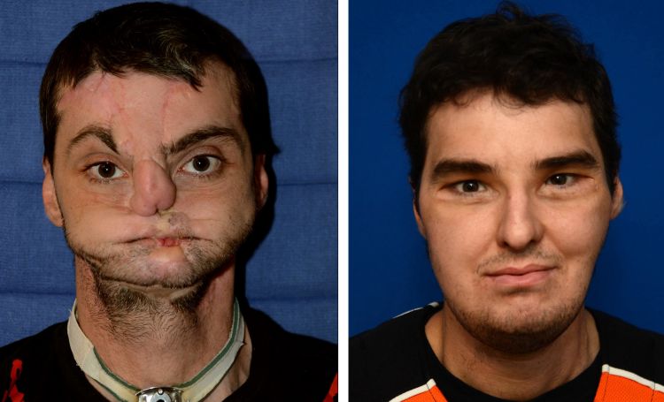 Before After 6 Foto transplantasi wajah bukti canggihnya medis