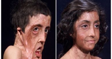 Before After 6 Foto transplantasi wajah bukti canggihnya medis