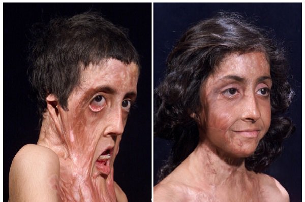 Before After 6 Foto transplantasi wajah bukti canggihnya medis