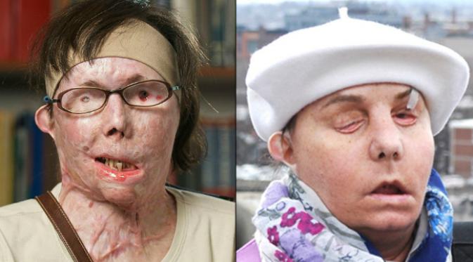Before After 6 Foto transplantasi wajah bukti canggihnya medis