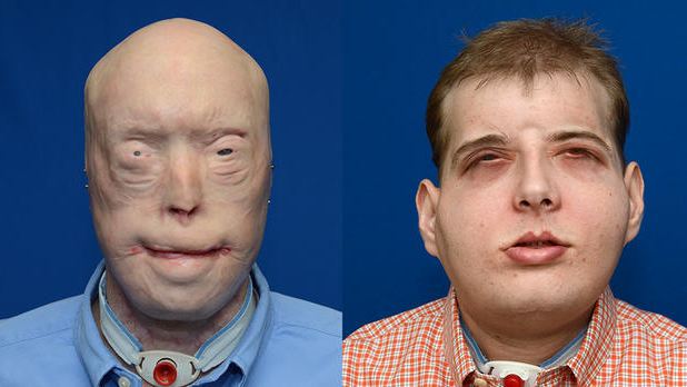 Before After 6 Foto transplantasi wajah bukti canggihnya medis