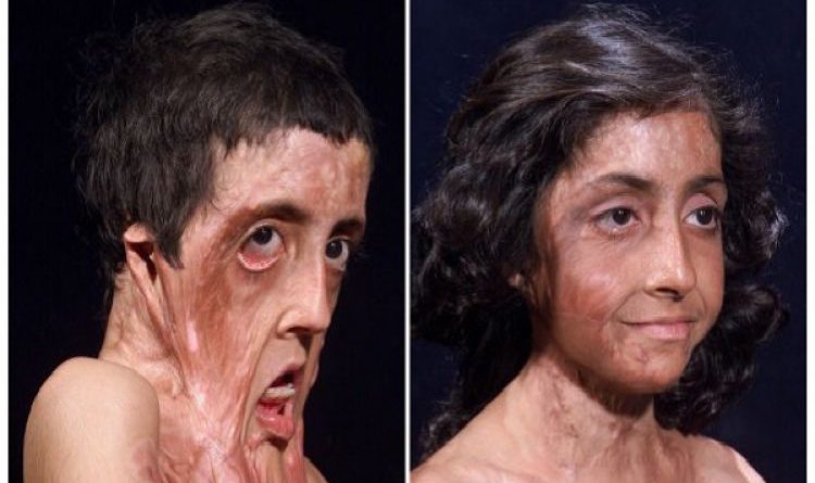 Before After 6 Foto transplantasi wajah bukti canggihnya medis