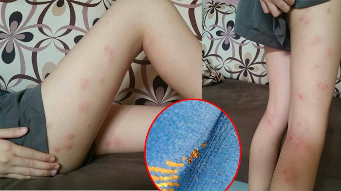 Hati-hati Bepergian Naik Bus, Kaki Cewek Ini Dipenuhi Tanda Merah