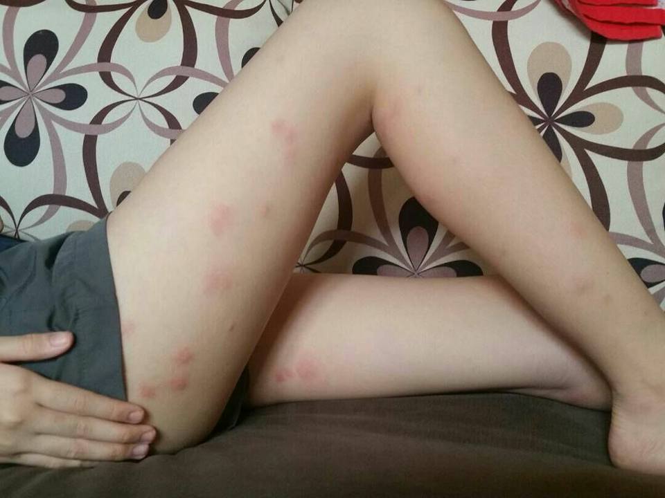 Kaki perempuan dipenuhi bekas gigitan usai bepergian naik bus (Faceboo/SoonTay)