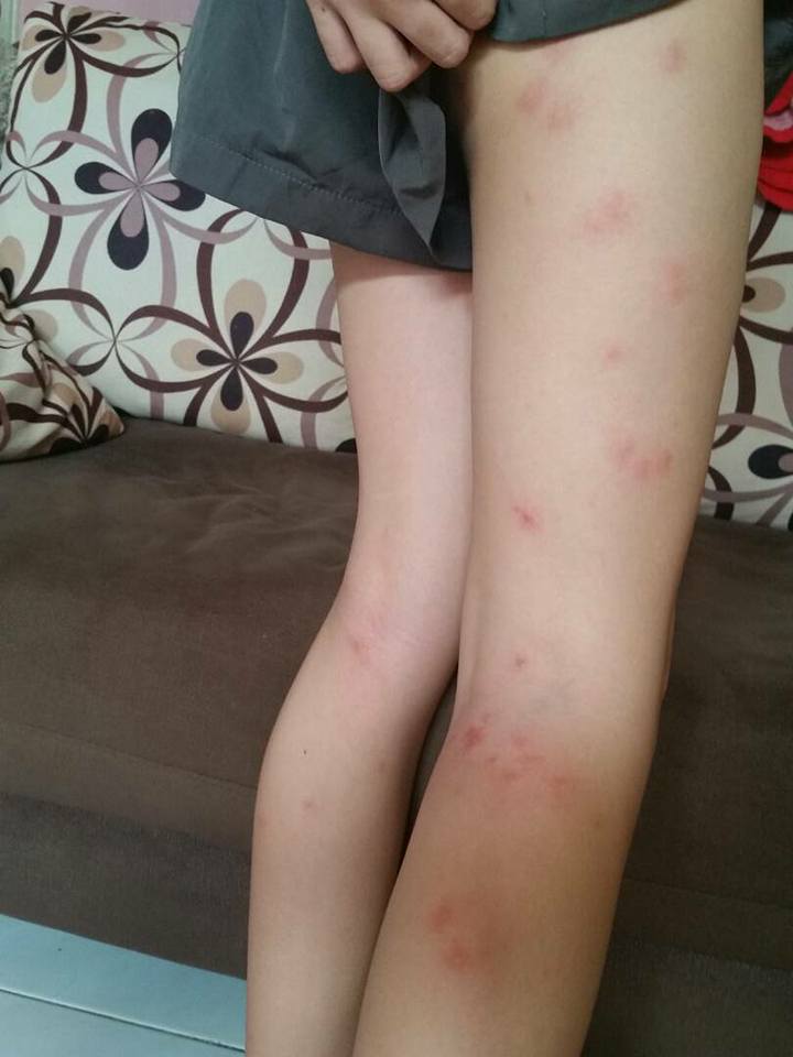 Kaki perempuan dipenuhi bekas gigitan usai bepergian naik bus (Faceboo/SoonTay)