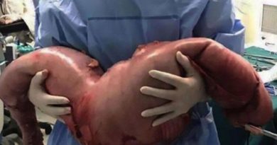 Mengeluh Sakit Dibagian Perutnya,Dokter Temukan Hal Mengerikan Didalamnya