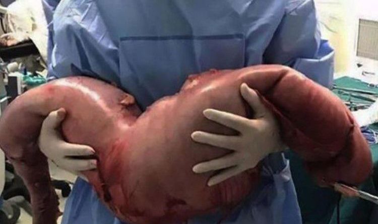 Mengeluh Sakit Dibagian Perutnya,Dokter Temukan Hal Mengerikan Didalamnya