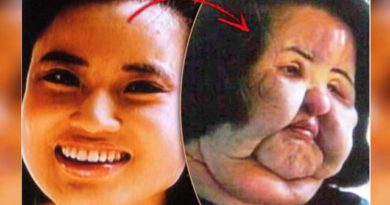 Mengerikan, Terobsesi Suntik Silikon Wajah Model Korea Ini Bengkak