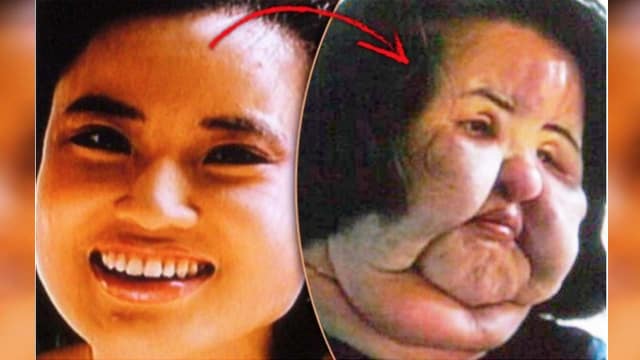 Mengerikan, Terobsesi Suntik Silikon Wajah Model Korea Ini Bengkak