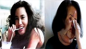 Mengerikan Terobsesi Suntik Silikon Wajah Model Korea Ini Bengkak