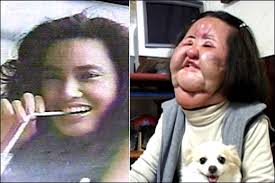 Mengerikan Terobsesi Suntik Silikon Wajah Model Korea Ini Bengkak