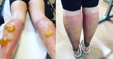 Akibat Terlambat Pakai Sunscreen, Betis Wanita Ini Jadi Seperti ini