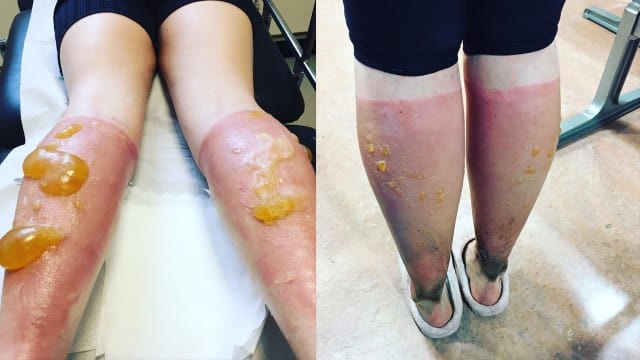 Akibat Terlambat Pakai Sunscreen, Betis Wanita Ini Jadi Seperti ini