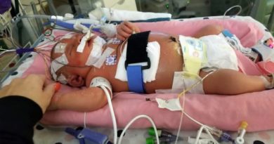 BAYI DI AS MENINGGAL KARENA TERTULAR HERPES MELALUI CIUMAN