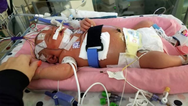 BAYI DI AS MENINGGAL KARENA TERTULAR HERPES MELALUI CIUMAN