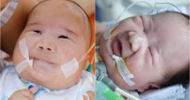BAYI MUNGIL ADAM FABUMI DENGAN PENYAKIT LANGKA VIRAL DI MEDSOS