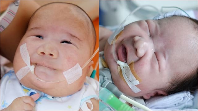 BAYI MUNGIL ADAM FABUMI DENGAN PENYAKIT LANGKA VIRAL DI MEDSOS