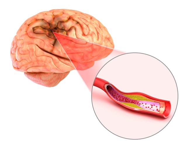 KENALI GEJALA STROKE DENGAN 3 TES SEDERHANA BERIKUT