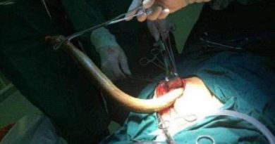 Memburu Sensasi Kenikmatan Seks yang Berujung Operasi