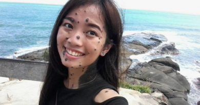 Wajah Dipenuhi Tahi Lalat Wanita Ini Mengikuti Audisi Untuk Miss Universe Di Malaysia