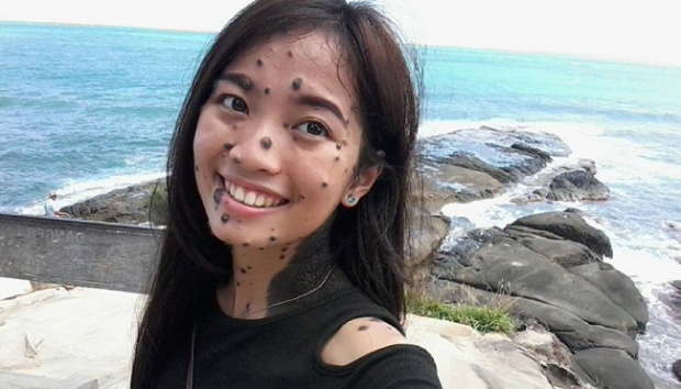 Wajah Dipenuhi Tahi Lalat Wanita Ini Mengikuti Audisi Untuk Miss Universe Di Malaysia