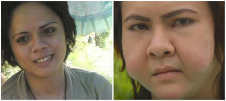 Akibat Filler Sembarangan Para Wajah Transgender ini Malah Hancur