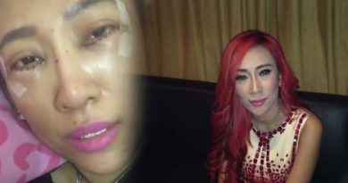 Bikin Ngilu Dewi Sanca Operasi Matanya Biar Terlihat Lebih Cantik