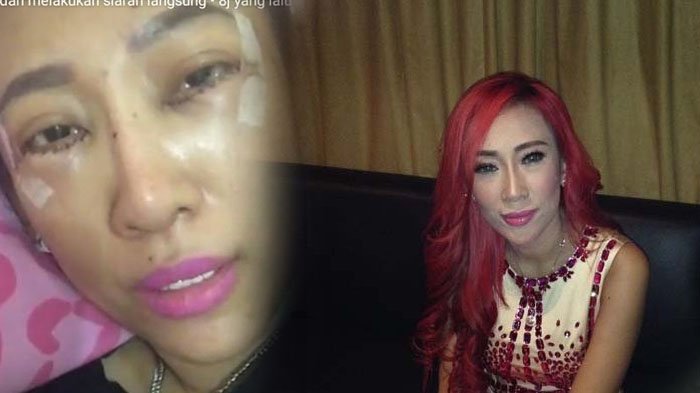 Bikin Ngilu Dewi Sanca Operasi Matanya Biar Terlihat Lebih Cantik