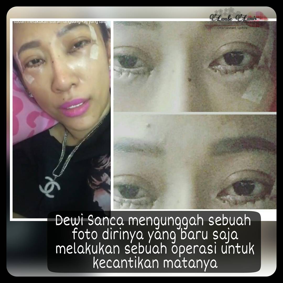 Bikin Ngilu Dewi Sanca Operasi Matanya Biar Terlihat Lebih Cantik