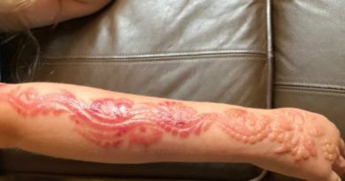Lukis Tato Hena Gadis kecil ini Terancam Cacat Permanen