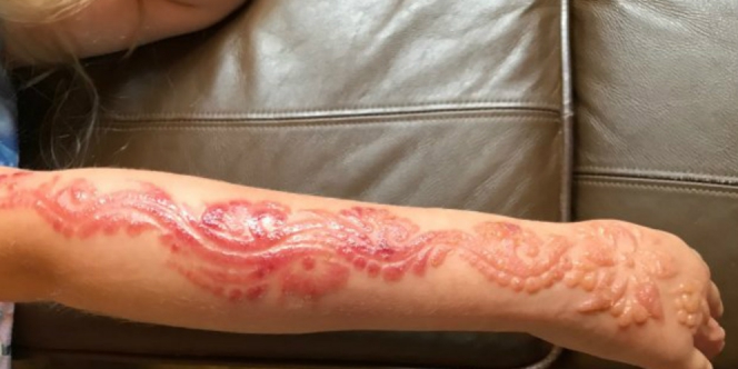 Lukis Tato Hena Gadis kecil ini Terancam Cacat Permanen
