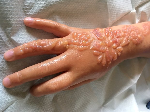 Lukis Tato Hena Gadis kecil ini Terancam Cacat Permanen