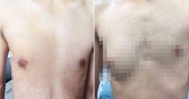 Pria Ini Tumbuh Payudara Akibat Sering Makan Makanan Kalengan