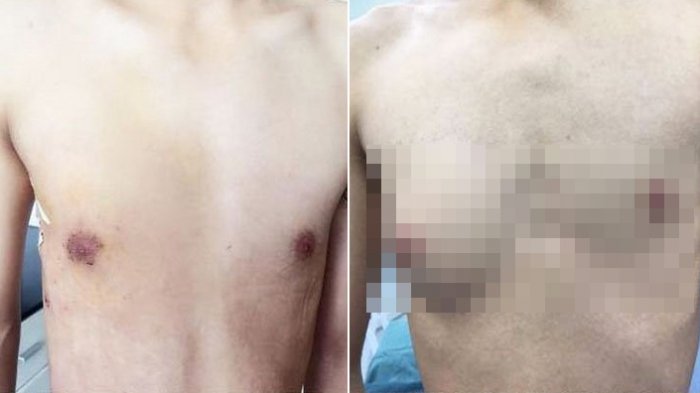 Pria Ini Tumbuh Payudara Akibat Sering Makan Makanan Kalengan