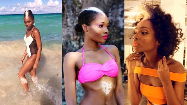 Wanita Ini Sukses Jadi Model Walau Punya Penyakit Genetik Piebaldism
