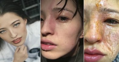 Akibat Pakai Essential Oil Wajah Wanita Ini Hancur Lebur