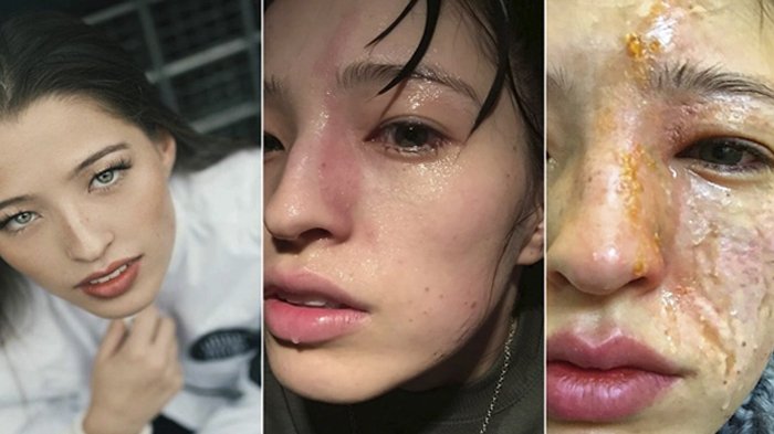 Akibat Pakai Essential Oil Wajah Wanita Ini Hancur Lebur