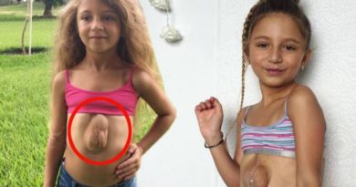 Cerita Virsaviya Borun, Gadis Kecil Pemilik Jantung di Luar Dadanya