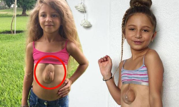 Cerita Virsaviya Borun, Gadis Kecil Pemilik Jantung di Luar Dadanya