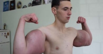 Kisah Unik Pria Badan Kurus Tapi Punya Otot Lengan Sebesar Hulk