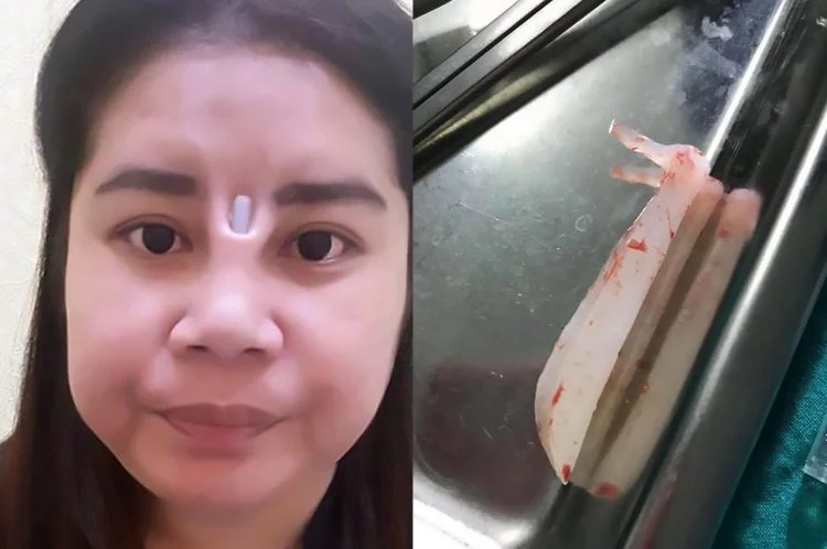 Bikin Ngilu! Jidat Gadis Thailand Ini Aneh Karena Oplas Murahan