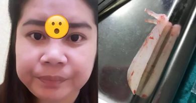 Bikin Ngilu! Jidat Gadis Thailand Ini Aneh Karena Oplas Murahan
