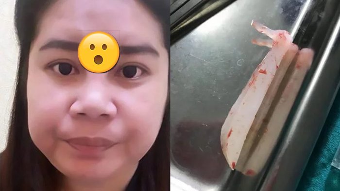 Bikin Ngilu! Jidat Gadis Thailand Ini Aneh Karena Oplas Murahan