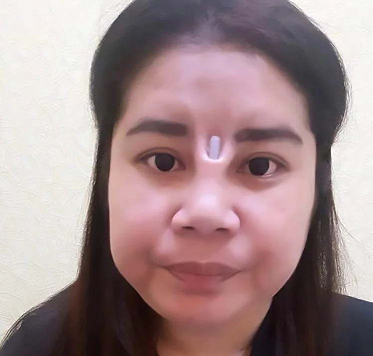 Bikin Ngilu! Jidat Gadis Thailand Ini Aneh Karena Oplas Murahan